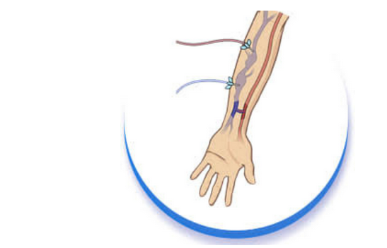 أسباب حدوث نزيف من الوصلة بعد جلسة الغسيل الكلوي